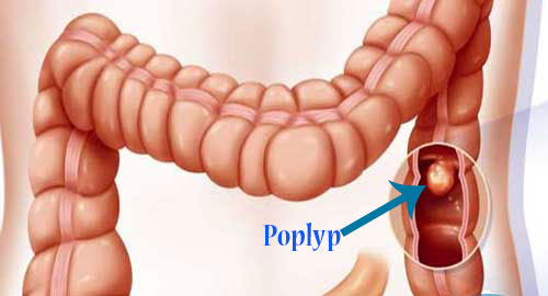 Bệnh polyp hậu môn 1