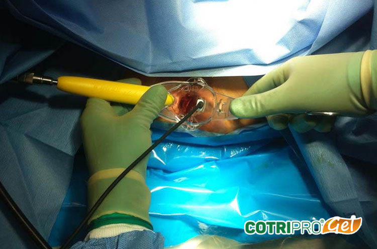 Phẫu thuật cắt trĩ bằng tia Laser 1
